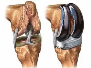 Total and Partial Knee Replacement (Knee Arthroplasty) in San José, Costa Rica by Dr. Aria Alexander Ravery Morovati at Dr. Aria Alexander Ravery Morovati — Orthopedics Procedure Abroad