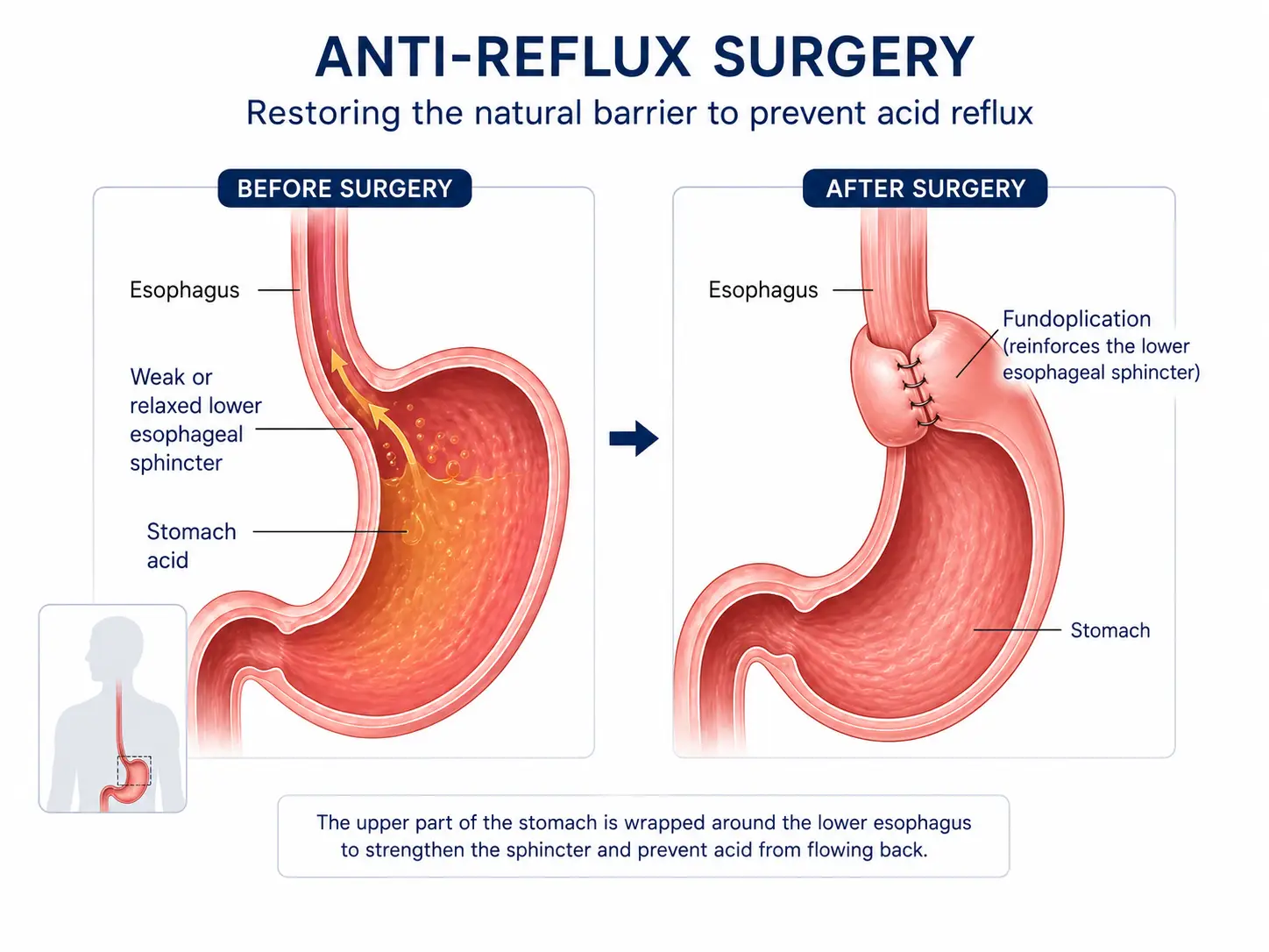 Revision Bariatric Surgery in Guadalajara, Mexico by Dr. Stefano Sereno Trabaldo — Procedure Gallery Photo
