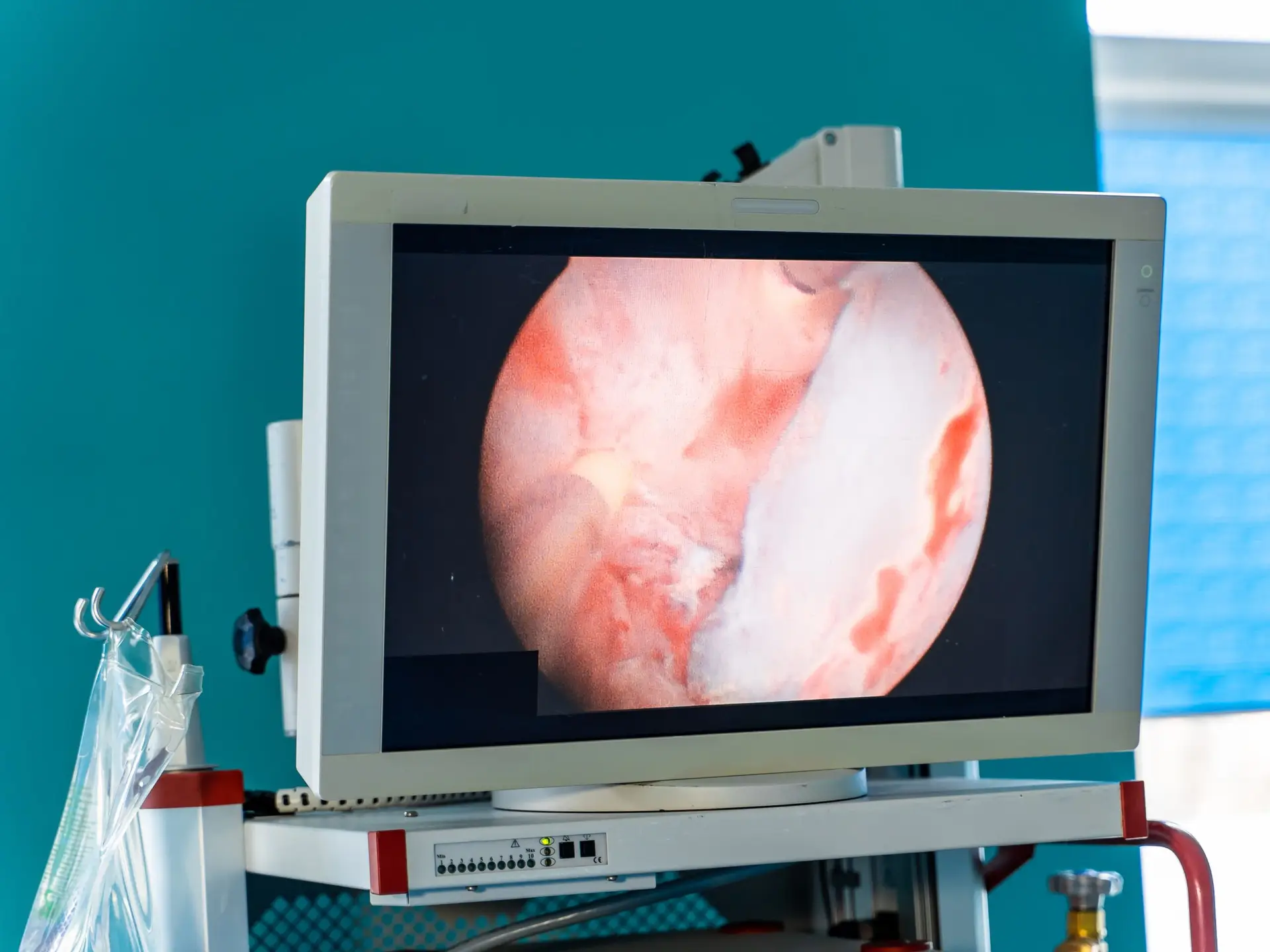 Video-Assisted Anal Fistula Treatment (VAAFT) in Brazil by Dr. Kaiser Jr. — Procedure Gallery Photo