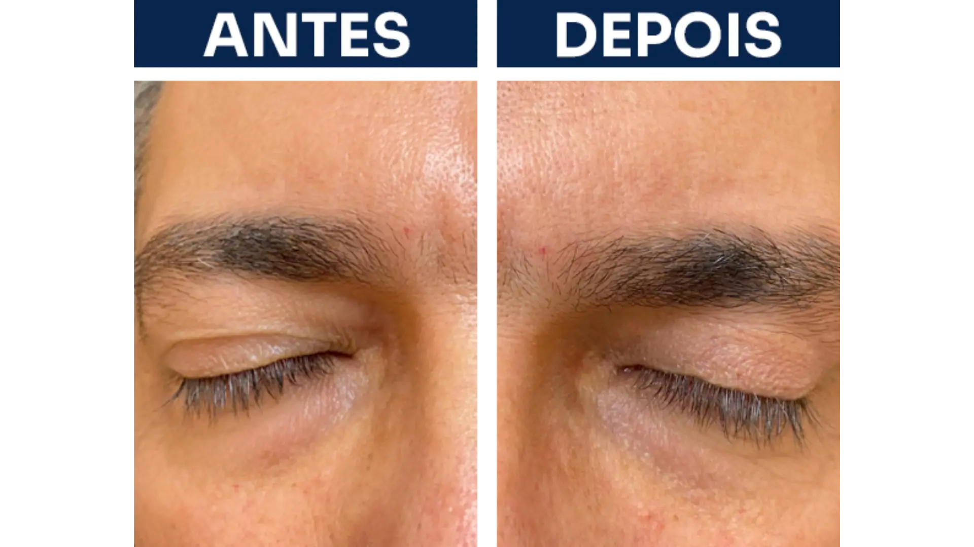 Blepharoplasty Surgery in Rio de Janeiro, Brazil by Dr. Esther Barrios — Procedure Gallery Photo