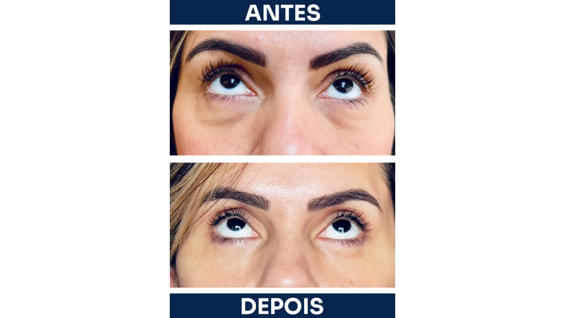 Blepharoplasty Surgery in Rio de Janeiro, Brazil by Dr. Esther Barrios — Procedure Gallery Photo