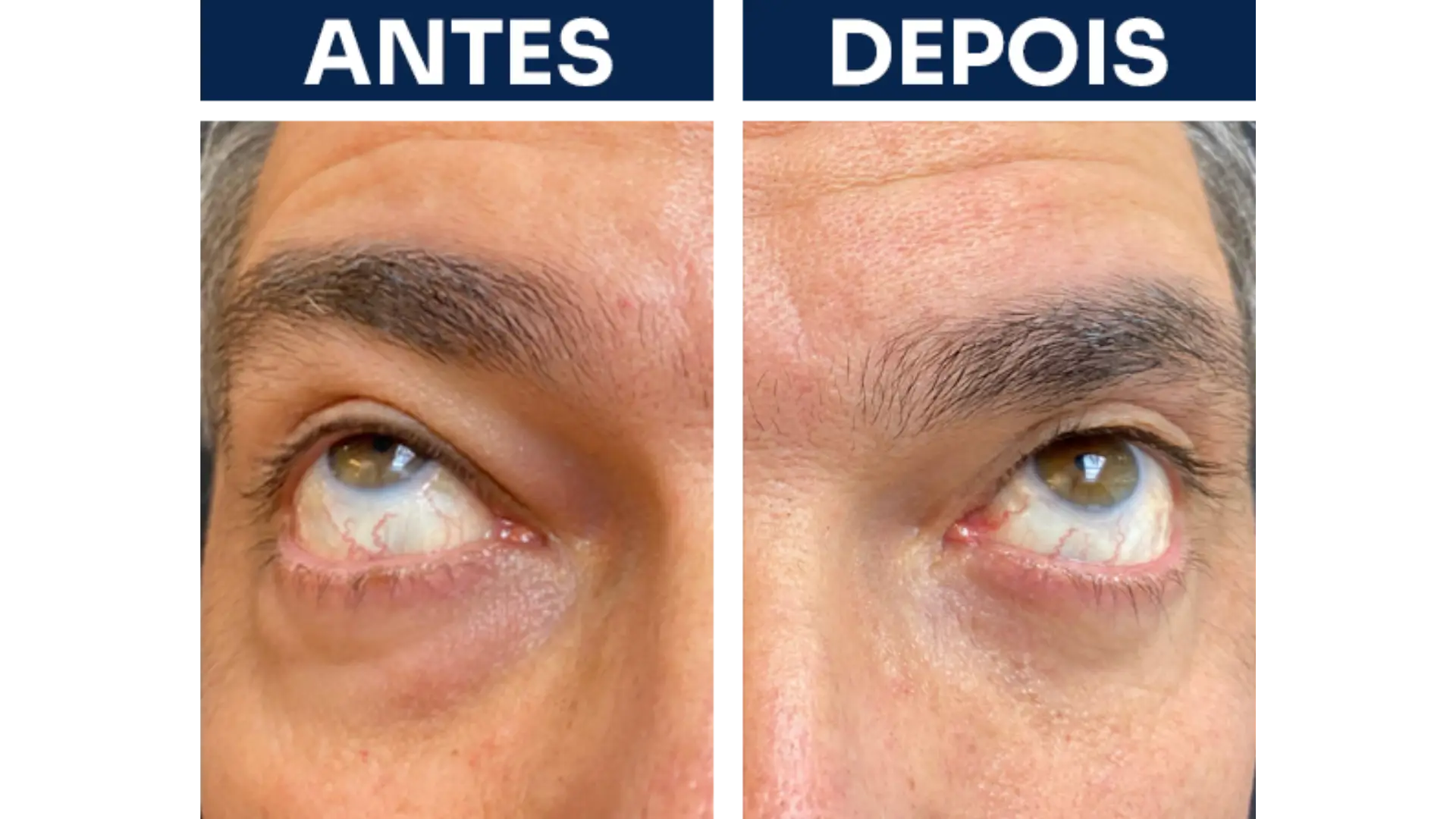 Blepharoplasty Surgery in Rio de Janeiro, Brazil by Dr. Esther Barrios — Procedure Gallery Photo