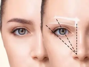 Eyebrow Transplant in Istanbul, Turkey by Esvita Clinic — Hair Restoration Surgery in Turkey