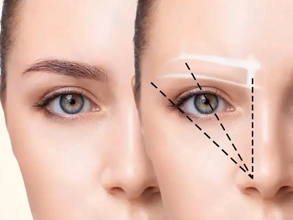 Eyebrow Transplant in Istanbul, Turkey by Esvita Clinic — Hair Restoration Surgery Procedure in Turkey