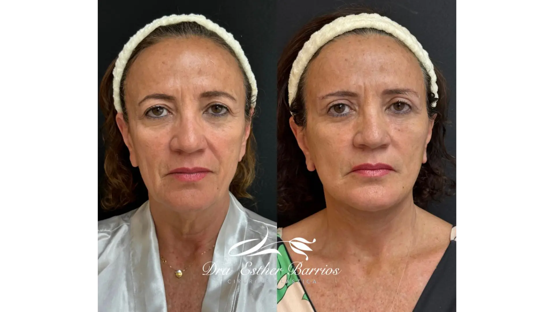 Facial Lift Surgery in Rio de Janeiro, Brazil by Dr. Esther Barrios — Procedure Gallery Photo