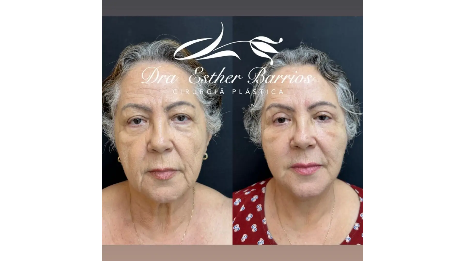 Facial Lift Surgery in Rio de Janeiro, Brazil by Dr. Esther Barrios — Procedure Gallery Photo