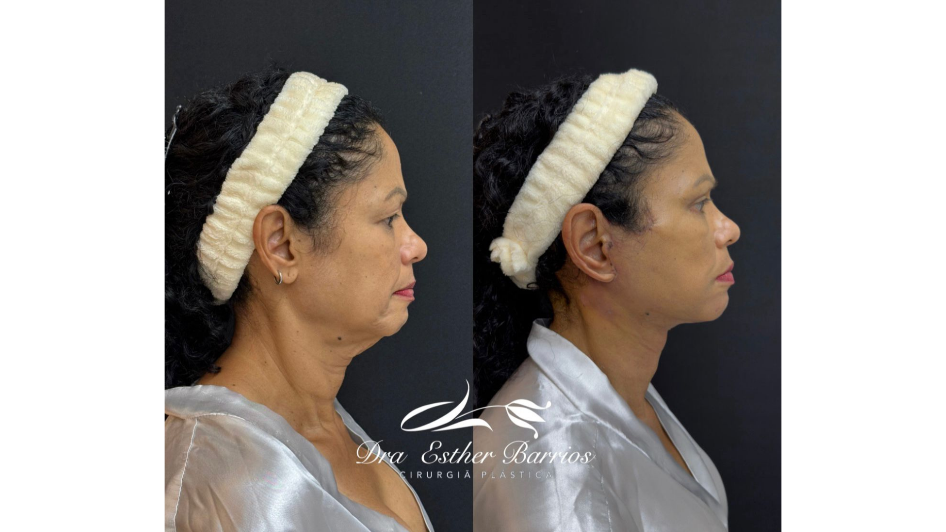 Facial Lift Surgery in Rio de Janeiro, Brazil by Dr. Esther Barrios — Procedure Gallery Photo
