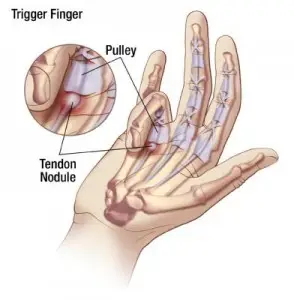 Trigger Finger Release in San José, Costa Rica by Dr. Aria Ravery at Dr. Aria Ravery — Orthopedics Procedure Abroad