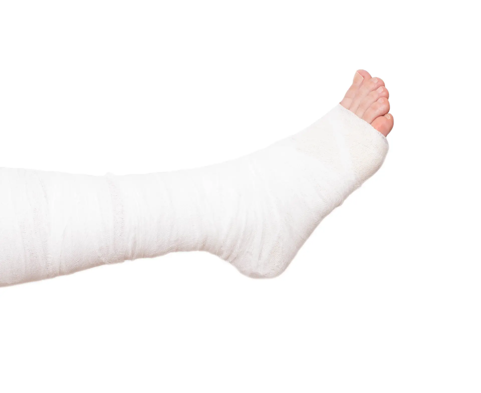 Simple and Complex Fracture Management in San José, Costa Rica by Dr. Aria Alexander Ravery Morovati — Procedure Gallery Photo