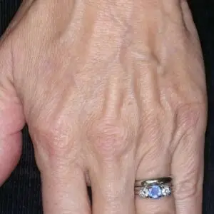 Hand Rejuvenation Clinics and Procedures Abroad