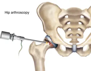 Hip Arthroscopy in Seoul, South Korea by Asan Medical Center — Orthopedics in South Korea