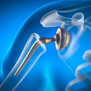 Shoulder Replacement Clinics and Procedures Abroad