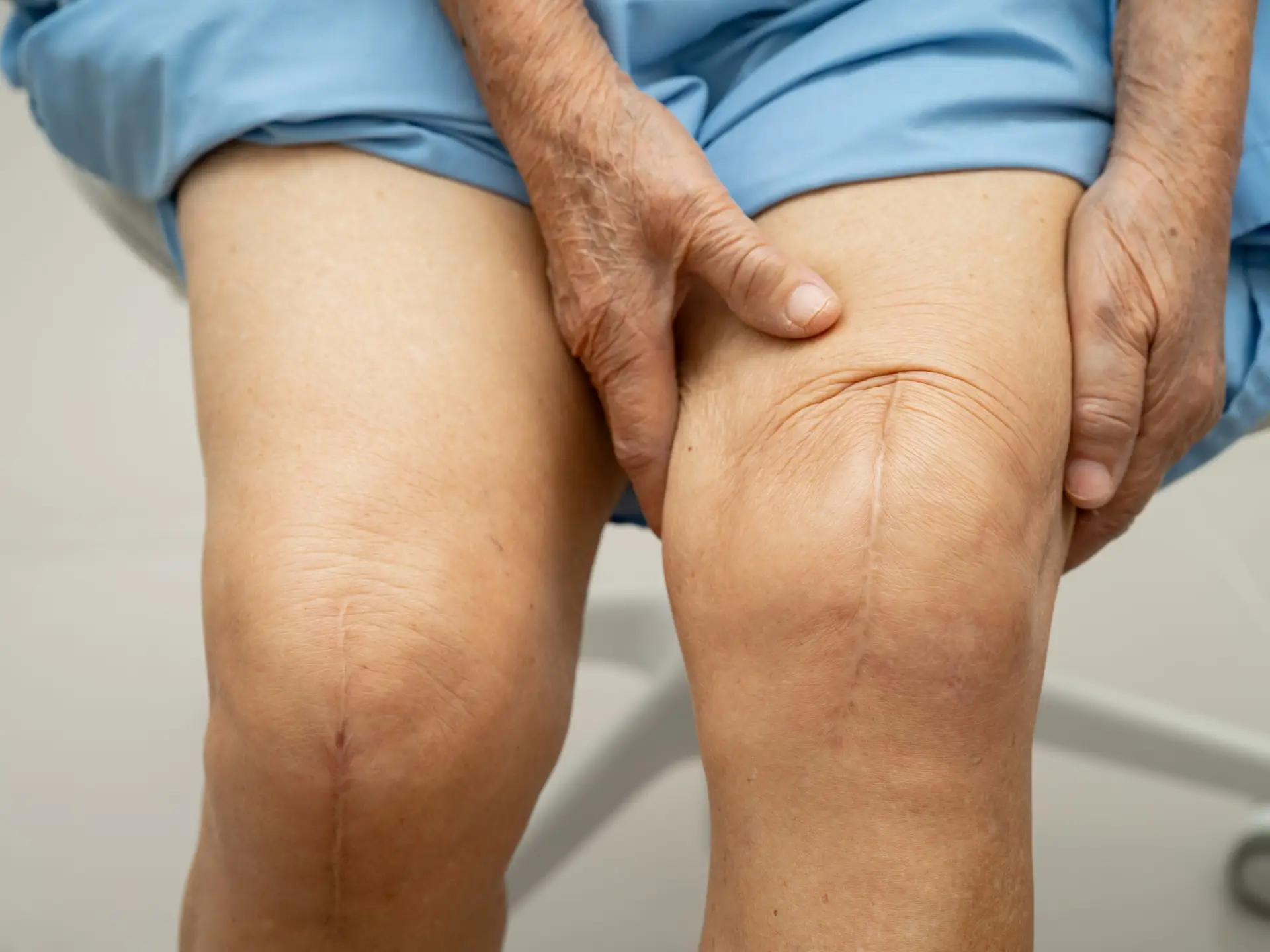 Robotic-Assisted Knee Replacement Surgery in San José, Costa Rica by Dr. Aria Alexander Ravery Morovati — Procedure Gallery Photo