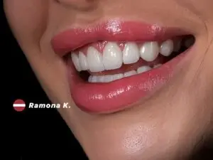 Laminate Veneers in Istanbul, Turkey by Esvita Clinic — Dentistry in Turkey