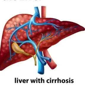 Cirrhosis Treatment Clinics and Procedures Abroad