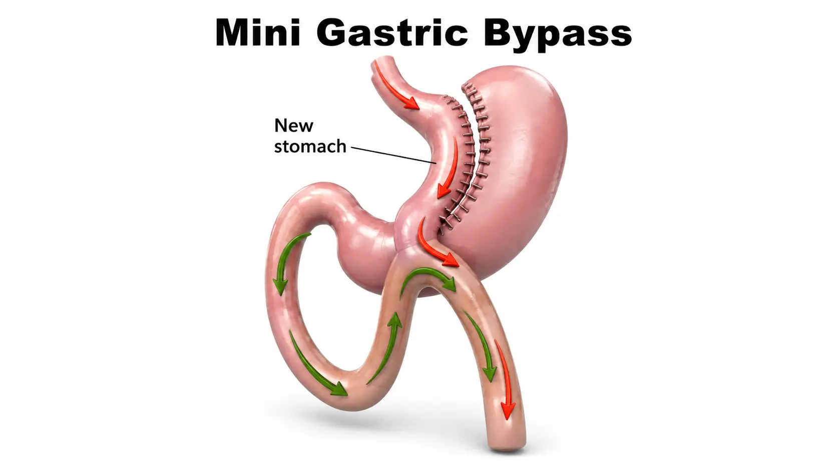 Mini Gastric Bypass in Brazil by Dr. Kaiser Jr. — Procedure Gallery Photo