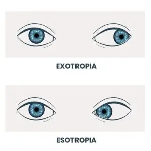 Strabismus (Squint) Treatment Clinics and Procedures Abroad