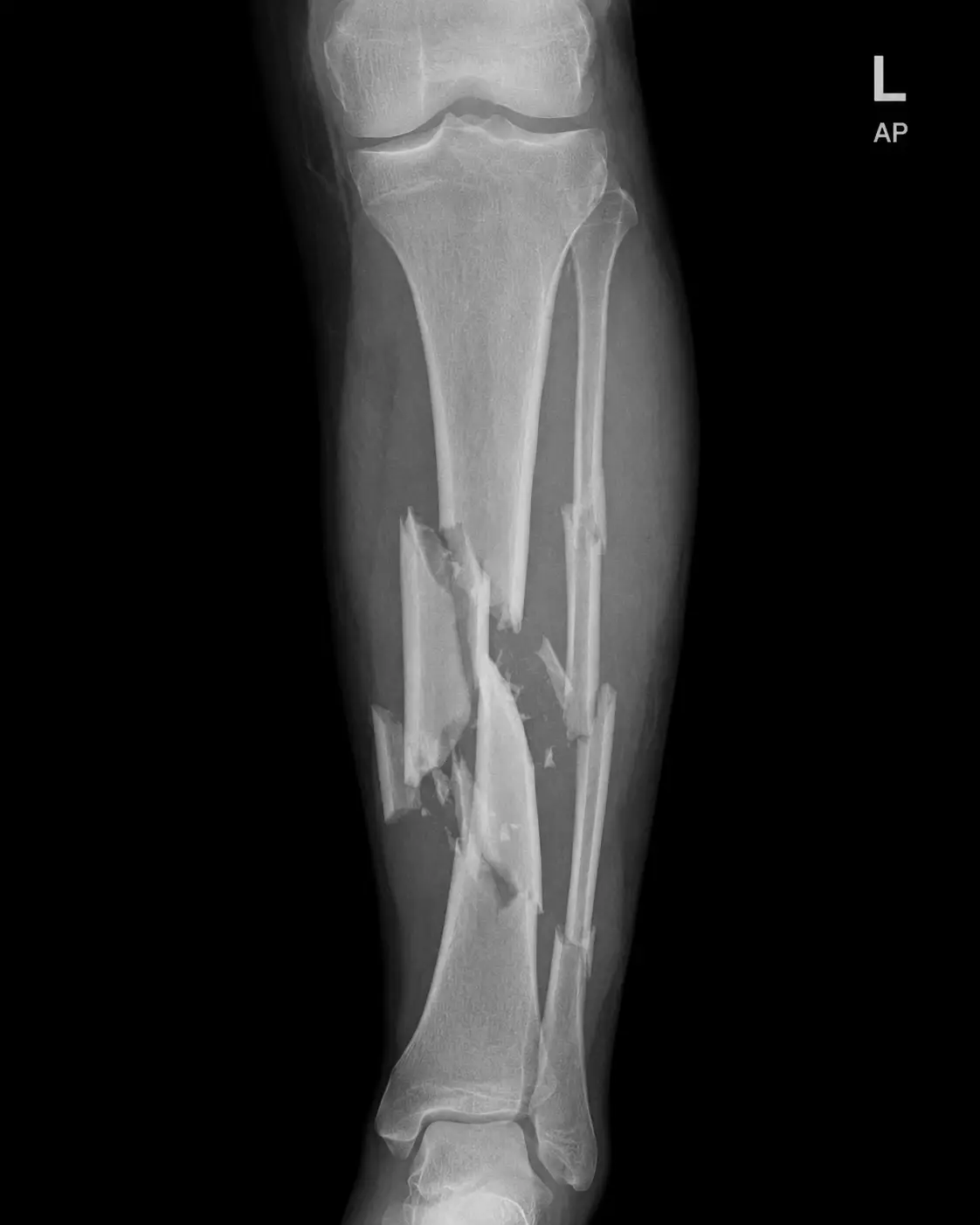 High-Energy Trauma Surgery in San José, Costa Rica by Dr. Aria Alexander Ravery Morovati — Procedure Gallery Photo