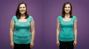 Revision Bariatric Surgery in Guadalajara, Mexico by Dr. Stefano Sereno Trabaldo at Dr. Stefano Sereno Trabaldo — Weight Loss Surgery Procedure Abroad